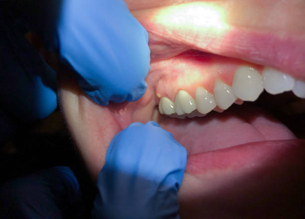 Best Emergency Denture Repair in Williamsport, PA